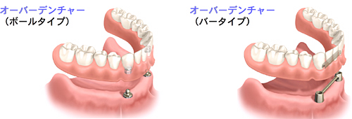 オーバーデンチャー