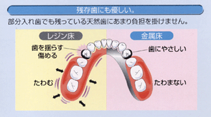 残存歯にも優しい