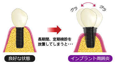 長期間、定期検診を放置してしまうと