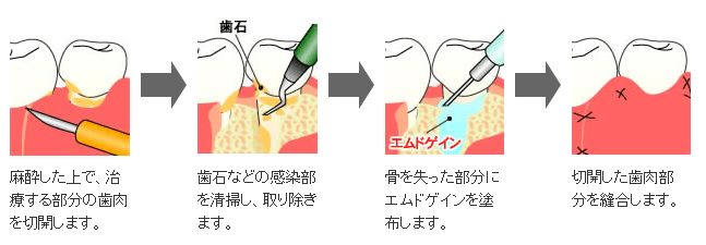 エムドゲイン法