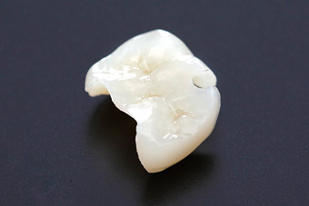 e-maxセラミックスインレー