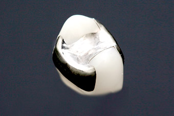 銀歯(保険適応)